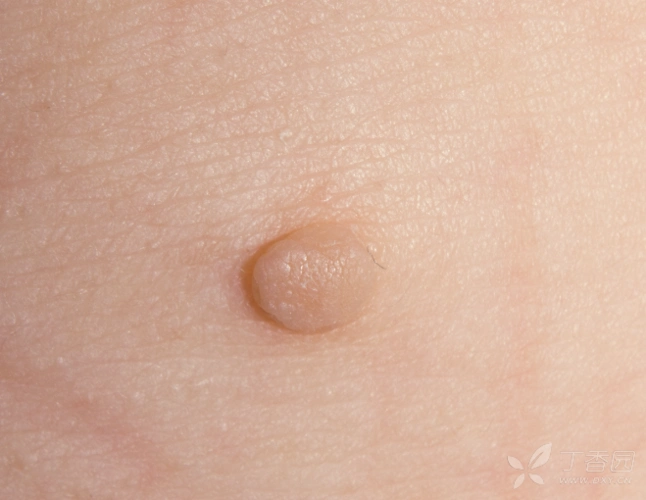 45岁女性,颈部体表肿物40余年(一周后公布答案) [病例帖]