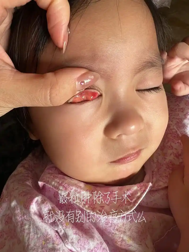 宝宝第二次长霰粒肿了,第一次没办法是选择了手术治疗, - 抖音