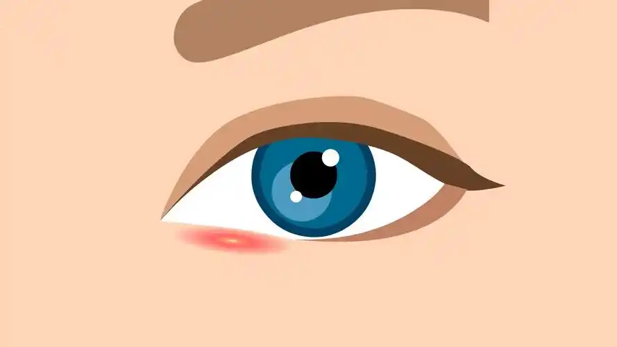 霰粒肿会自己破吗