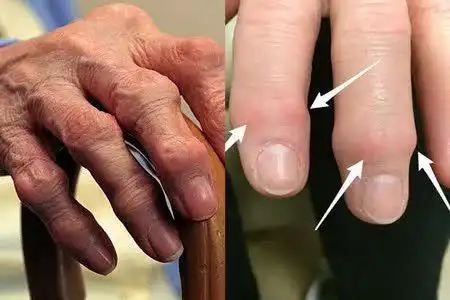 手指关节疼痛,肿大,是骨关节炎还是类风湿关节炎呢?