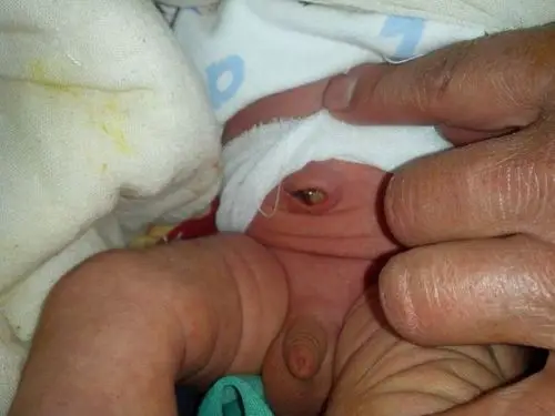 新生儿14天脐带才掉,肚脐里面有白色分泌物,附图片,大家帮忙看看是不