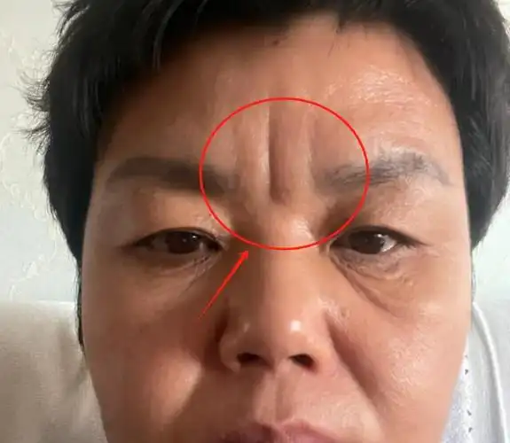 川字纹怎么才能去除?肉毒素和玻尿酸填充哪个效果好?