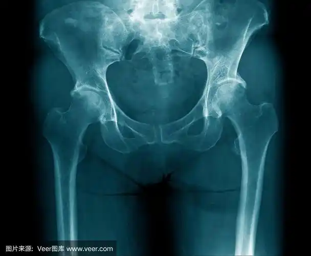 x线影像骨盆骨