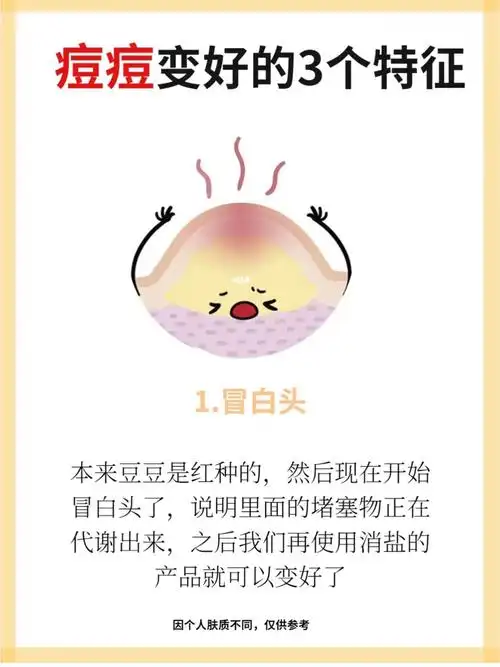 痘痘变好的3个特征!你符合几个?