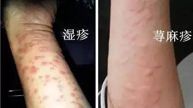 简单2点,正确区分湿疹和荨麻疹!