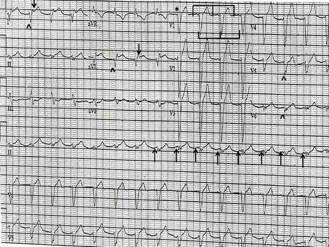挑战心电图房室分离的原因是什么