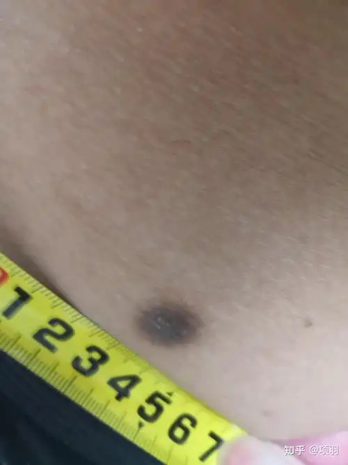 想知道这2个是什么,皮肤纤维瘤吗?还是什么东西需不需要割掉.