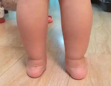 外翻是什么意思网络用语,关于儿童足外翻 - 玉三网