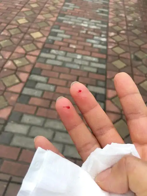 我被第一次见面的大狸花猫抓伤了内有见血受伤图我无碍别担心