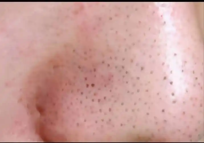 鼻子上有黑头怎么办鼻子上总长黑头如何科学有效去除