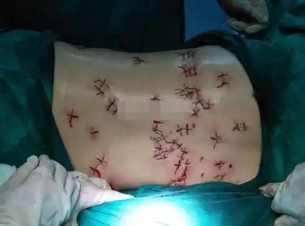 经诊断,女子伤情很重,生命垂危:1,失血性休克;2,全身多处锐器伤;3