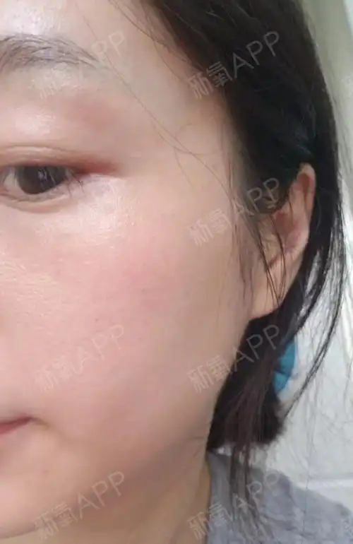 光子嫩肤做完之后结痂很快,脱落之后就可以看到白净的_圈子-新氧美容