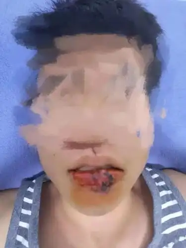 吓人泉州一宠物店店员给狗打针时被狗咬掉下嘴唇