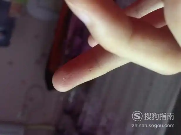 被蝎子蛰了如何处理