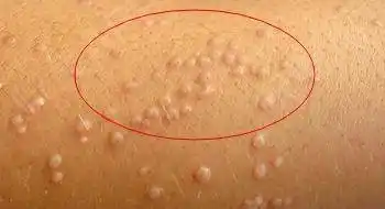 疣图片可能引起不适