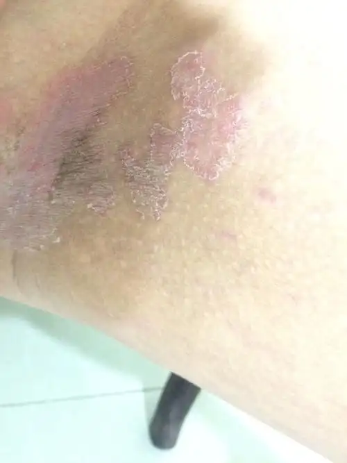 大腿内侧这样了,怎么办需要怎么办啊