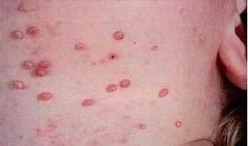 黔东南州疣专家_黔东南州治疗疣哪个专家好_黔东南州治疗疣最好的专家