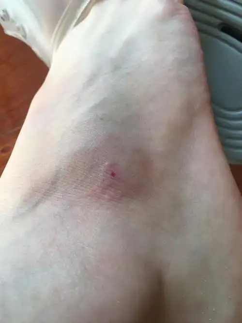 自家养的小泰迪咬到脚了 需要注射狂犬疫苗吗?