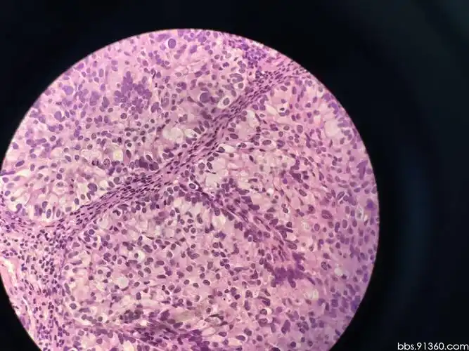 膀胱顶部见一2x2厘米的菜花状肿物2016.12.