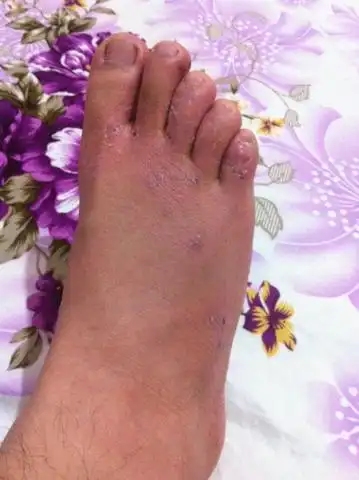 脚气抓破皮导致脚面浮肿,求大神,该怎么办,已经挂了3天点滴了,用的是