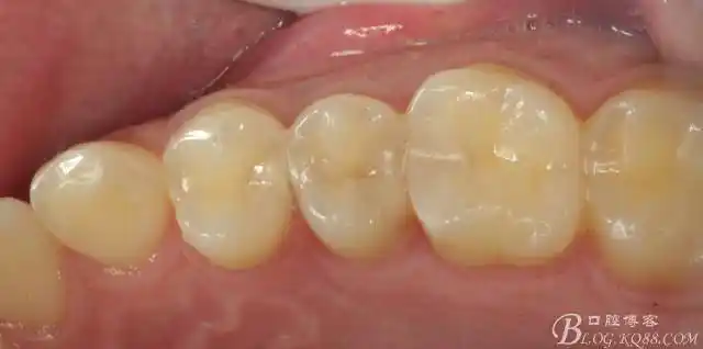 邻面龋的可怕