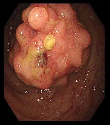 一个患者体内生长有三个不同级别的腺瘤,如果能提早做一次结肠镜检查