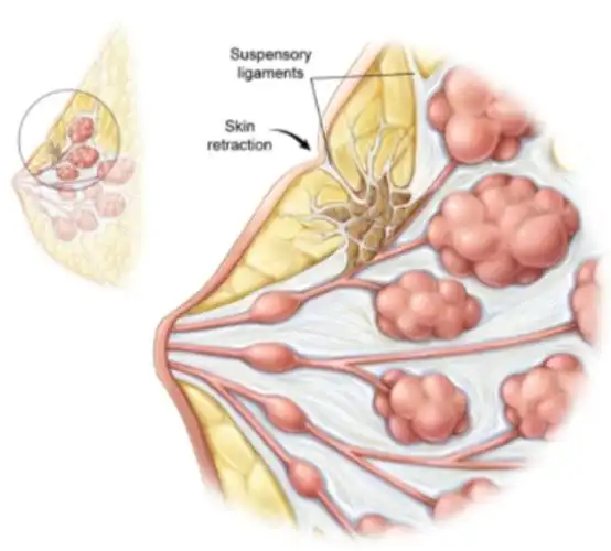 乳腺癌丨乳房皮肤的小酒窝不可爱但可以癌