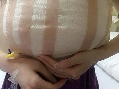 我停了哺乳,我的乳头在生育前有点大,现在生育完,更_圈子-新氧美容