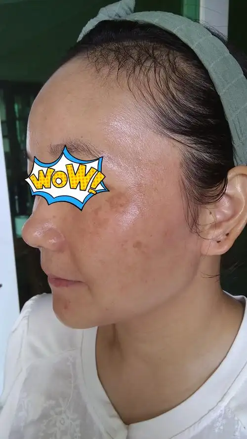 远离斑花你脸上是哪种斑