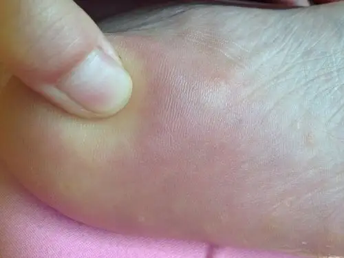 脚板底长了好多白色的像水泡一样的小点点,不痛不痒,是什么东西啊