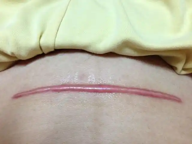 女人剖腹产疤痕只是难看吗