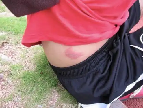 外出郊游住民宿,女孩一觉醒来发现"几乎毁容"!这个动作千万别随便做