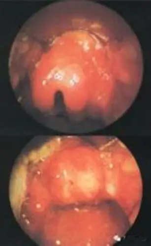 皮脂喉粘液腺囊肿图片大全_有来医生