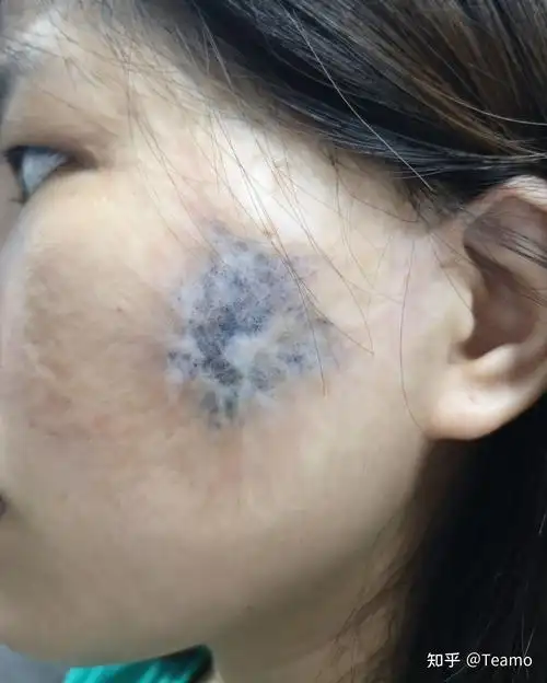 扩张器术后疤痕恢复ing