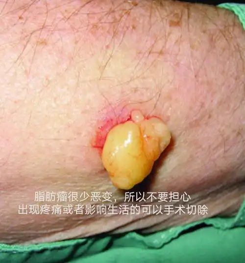 脂肪瘤需要治疗吗
