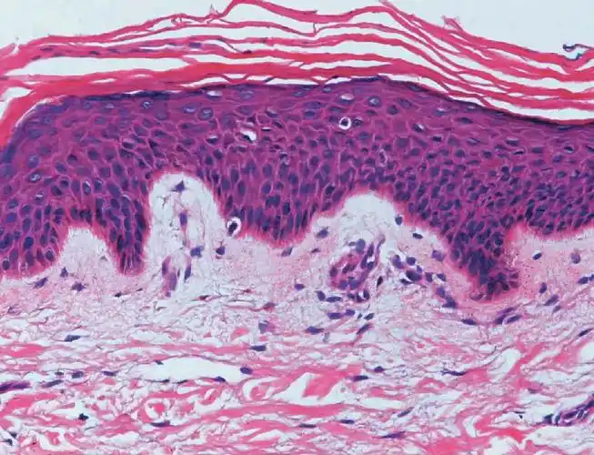 两者迥然不同,角质形成细胞具有细胞间桥以及丰富的胞质,用he染色即可