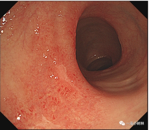 肠道病变内镜图片