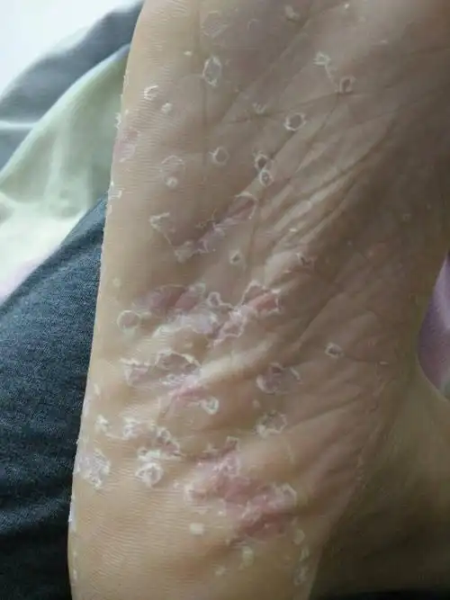 脚掌脱皮了,这怎么办?求救!