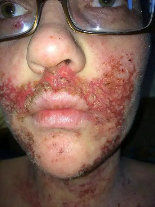 女子患严重湿疹无法拥抱儿子用剪刀刮掉皮肤