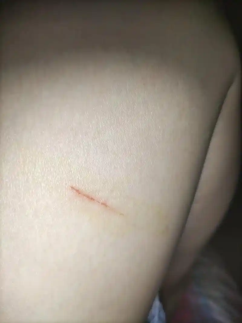 前天晚上被小猫抓伤了,第一个抓痕是今天才发现的,第二个抓痕被 - 抖