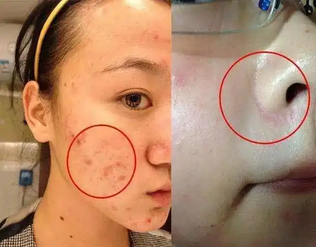 女人脸上长螨虫惨不忍睹,药店2块钱中药粉,去除螨虫更亮肤色