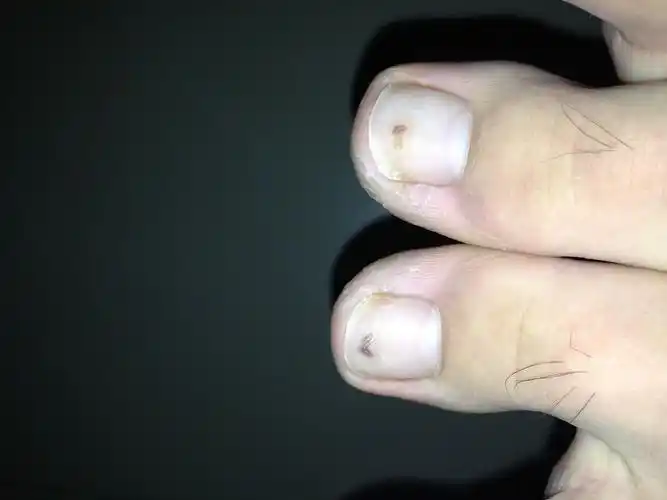 我的左右大脚趾指甲里对称长有绿豆大小的黑斑,怎么回事啊?急求!