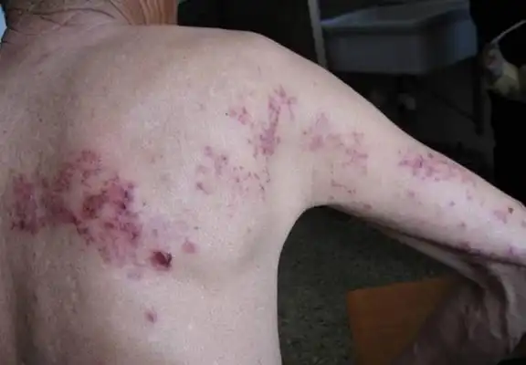 毒疮图片 (20)_有来医生