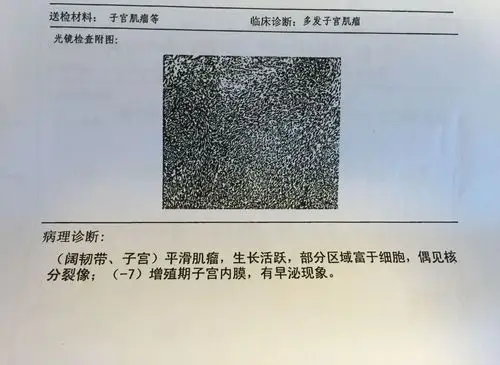 23:53    浏览  33333  满意回答 你好,病理报告上来看,子宫肌瘤细胞