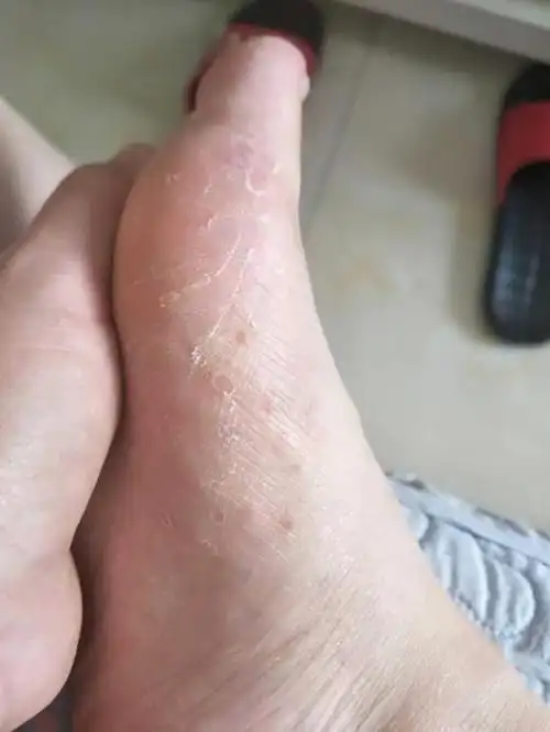 医生坦言维生素b1是脚气病的克星可惜知道的人太少了