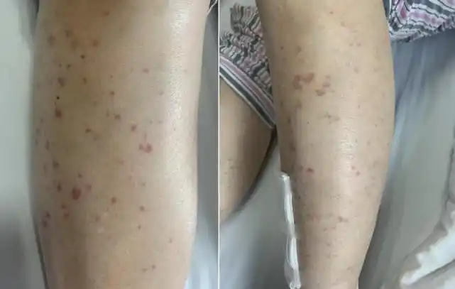 一度被疑早期肺癌,igg4明显升高,系感染所致?