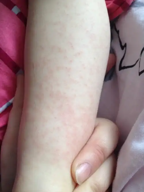 宝宝身上出红色的疹子一片一片,有点痒,四肢较多