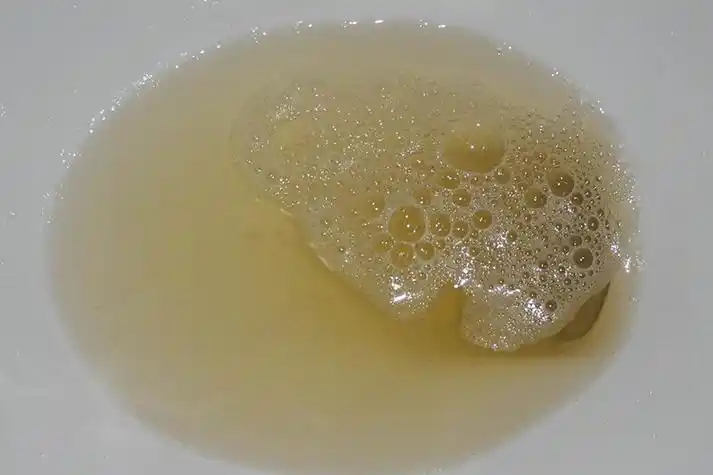 正常的泡沫尿图如果尿液表面漂浮着一层细小的泡沫,且久久不散,则很