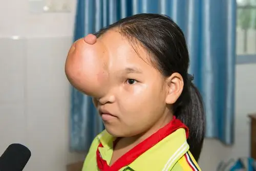 爱的呼唤前额长个疙瘩的小姑娘急盼大家相助