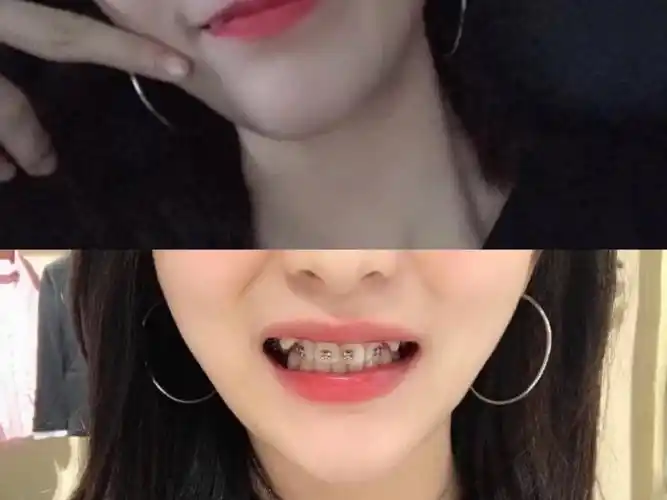 为什么虎牙最不能拔?